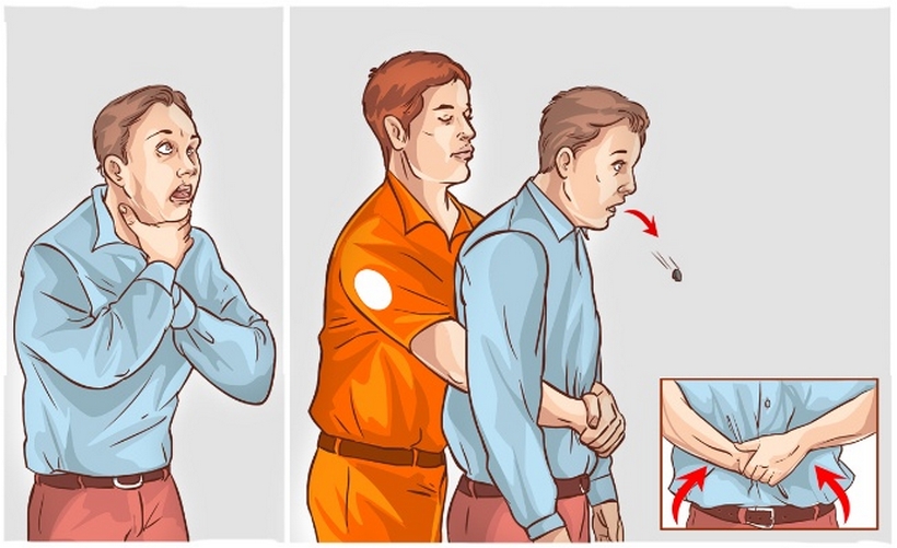 Her an başınıza gelebilir, Heimlich manevrası nedir ? Nasıl yapılmalıdır?